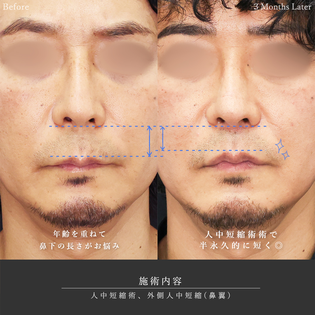 人中短縮術(リップリフト)・外側人中短縮術の症例写真 施術前後 