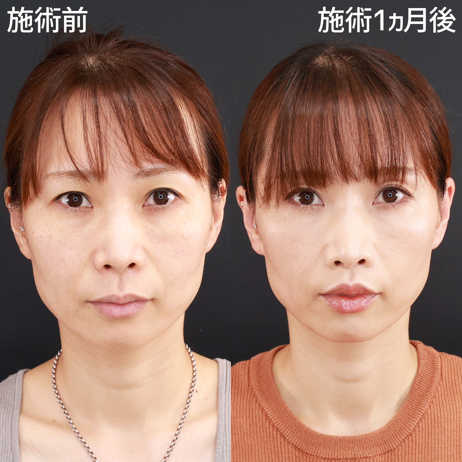 人中短縮術(リップリフト)・外側人中短縮術/TAC式 鼻翼縮小術（小鼻縮小）の症例写真 施術前後 
