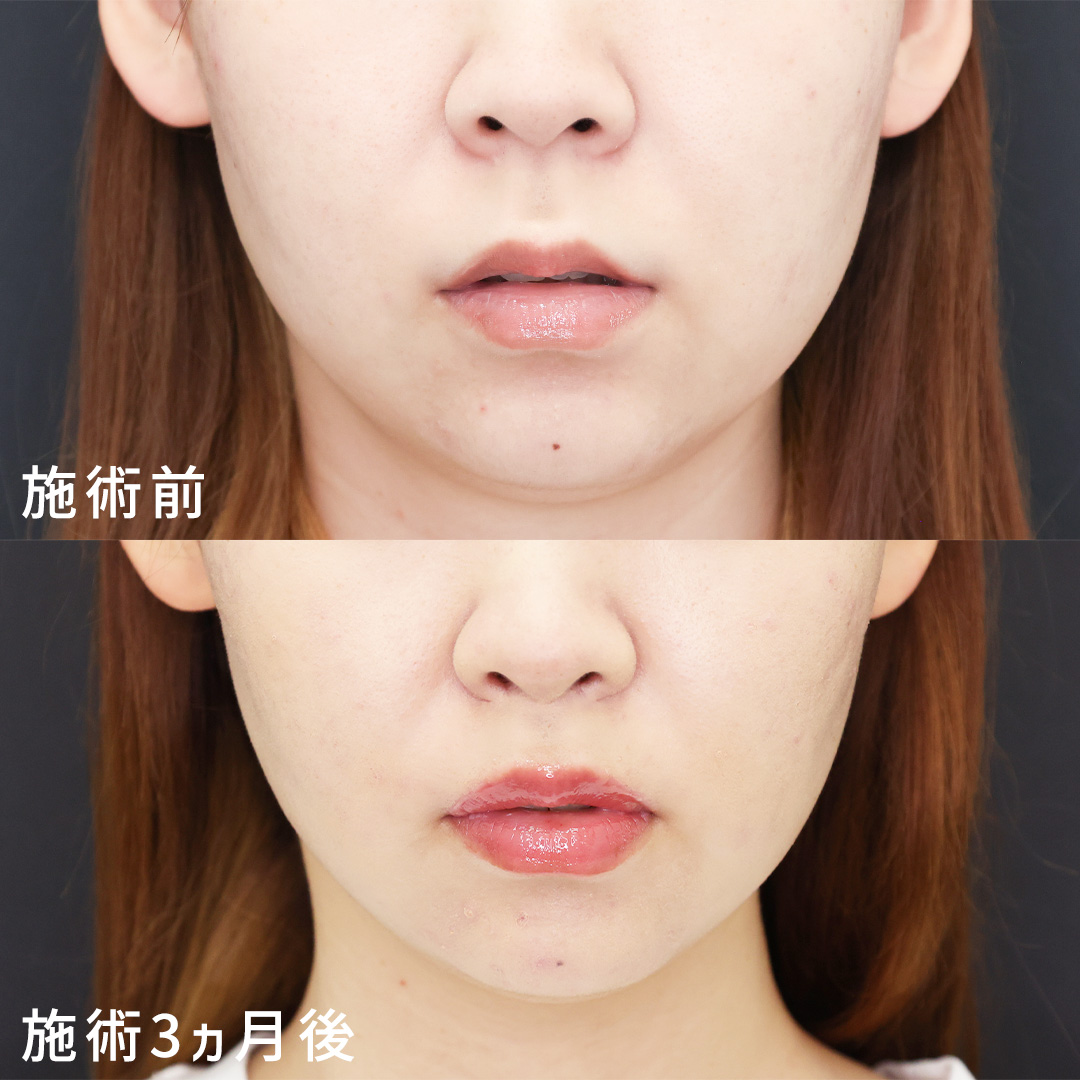人中短縮術(リップリフト)・外側人中短縮術の症例写真 施術前後 