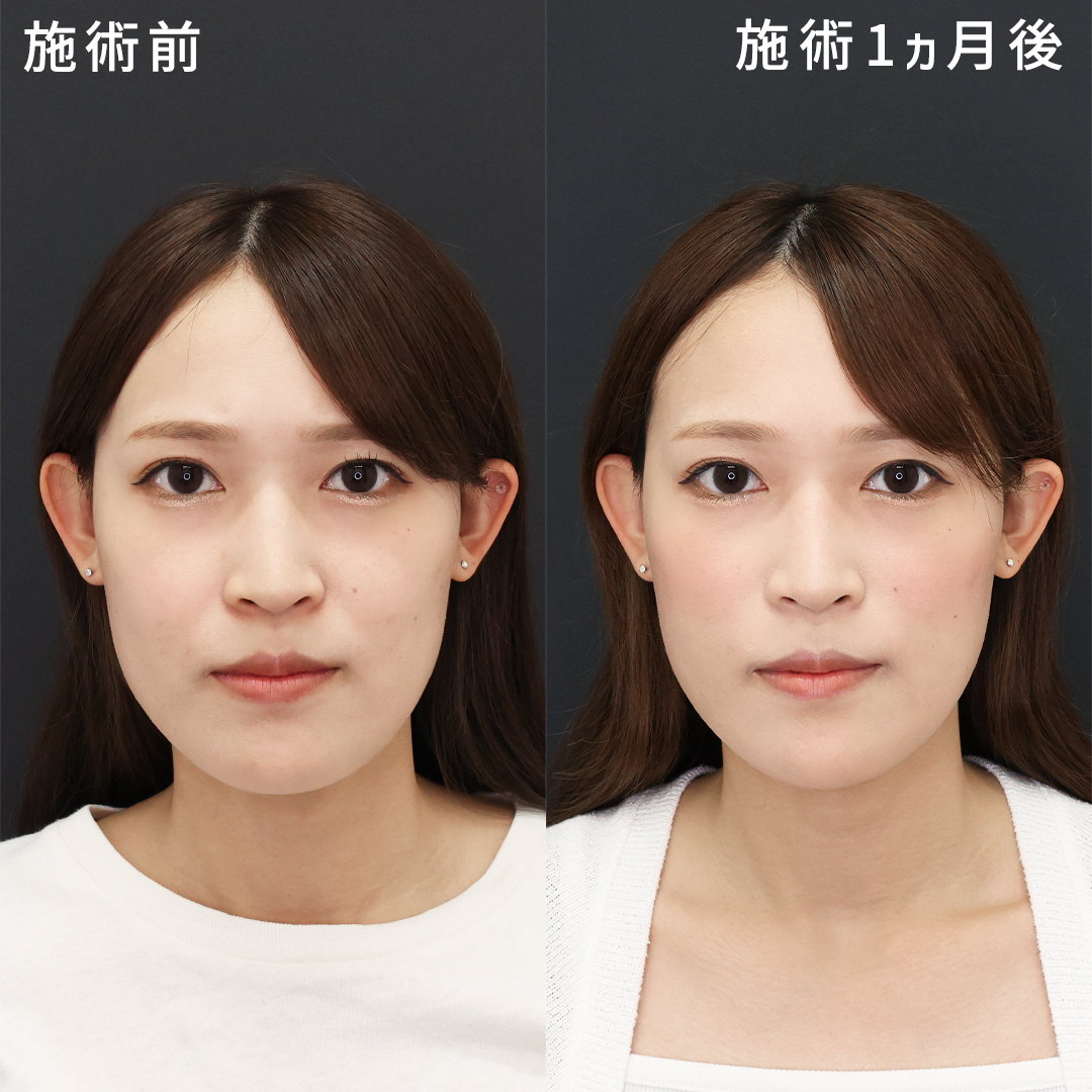 ナゾラビアルファット除去の症例写真 施術前後 
