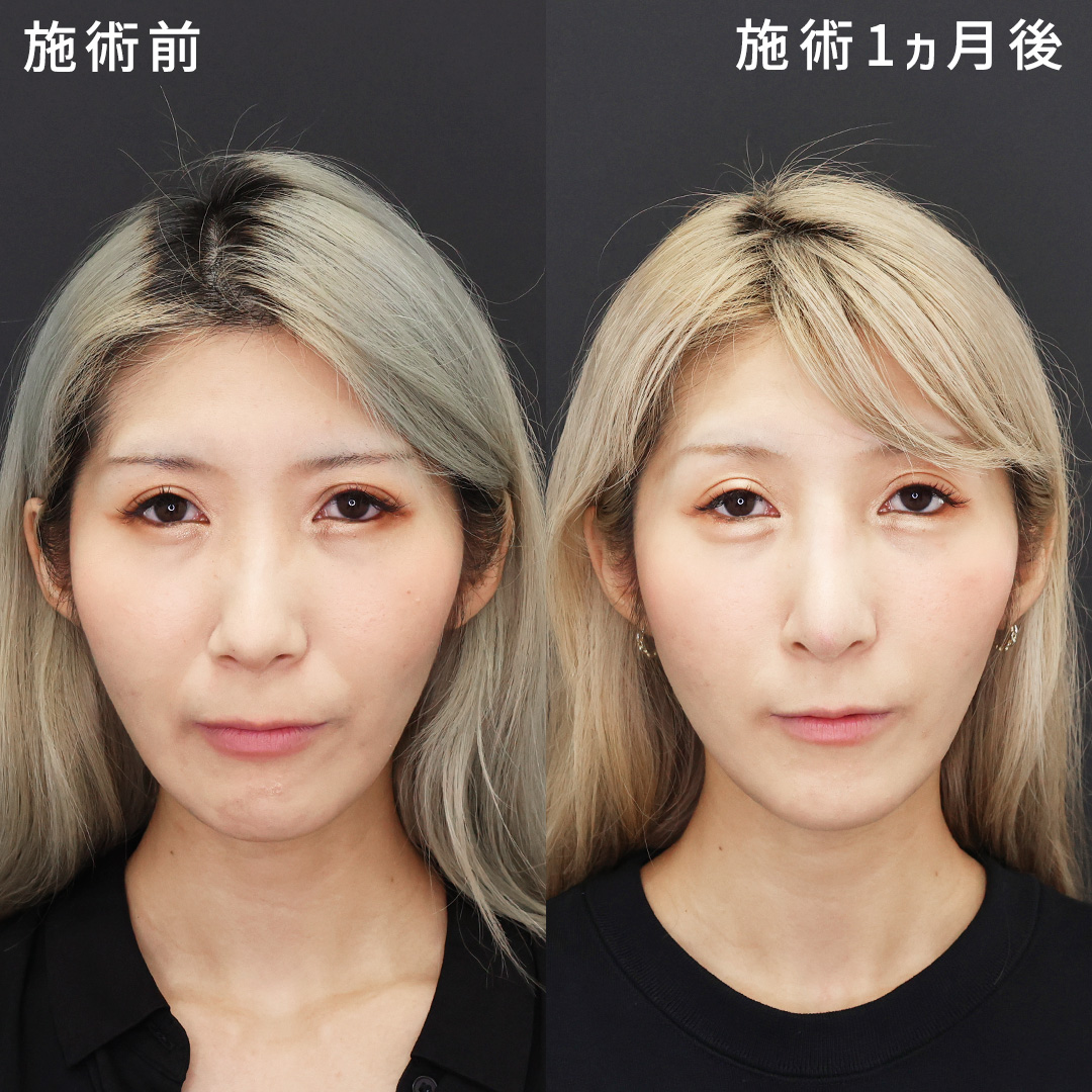 口整形：その他（ほうれい線剥離など）/鼻中隔延長術/鼻尖形成・鼻尖縮小の症例写真 施術前後 