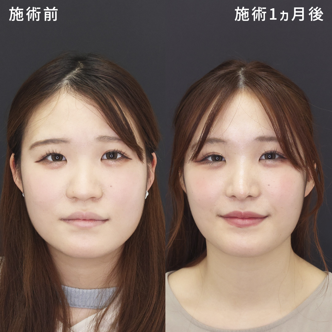 鼻尖形成・鼻尖縮小/鼻先軟骨移植/鼻：その他の症例写真 施術前後 