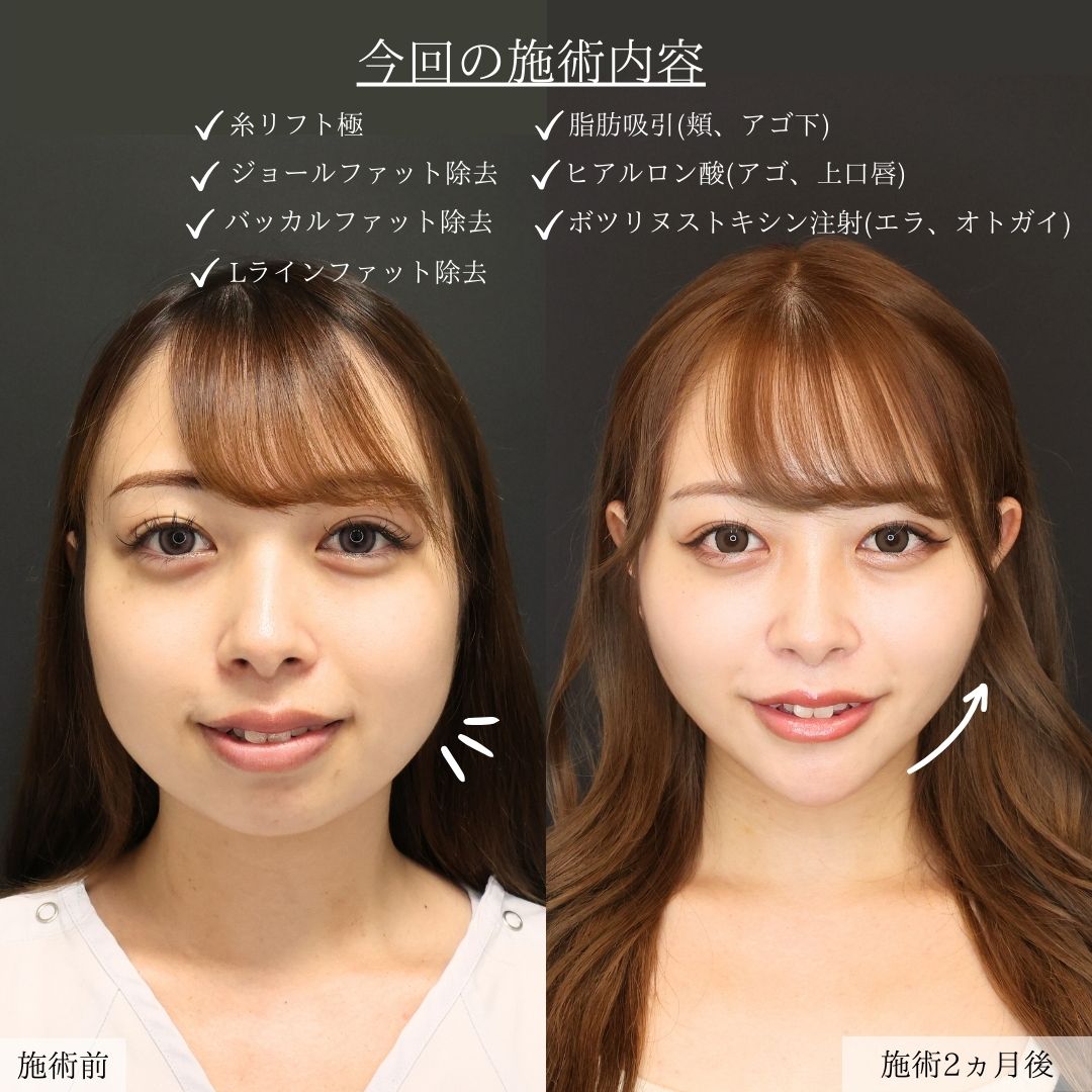 バッカルファット除去/顎下の脂肪吸引/ジョールファット除去の症例写真 施術前後 