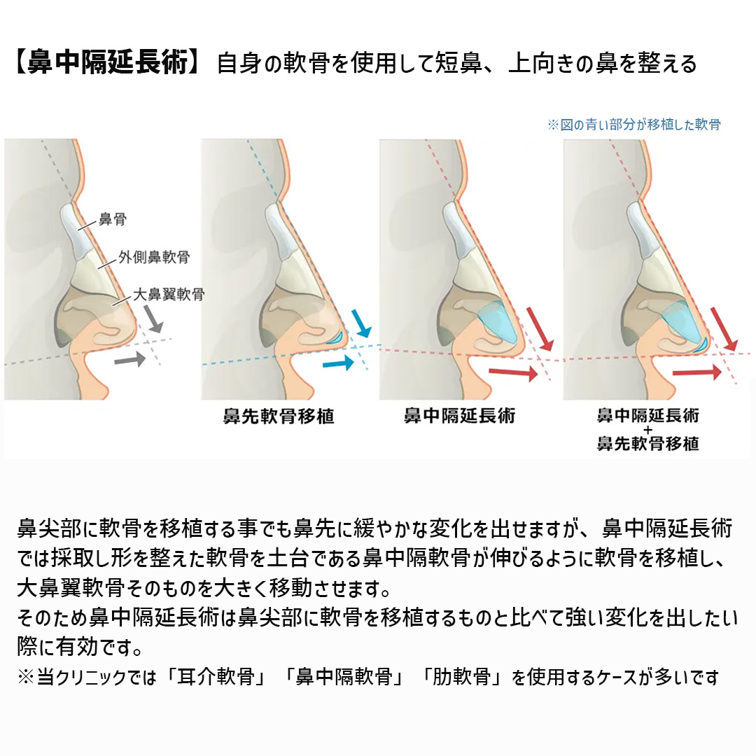 鼻中隔延長術/鼻尖形成・鼻尖縮小/鼻先軟骨移植の症例写真 施術前後 