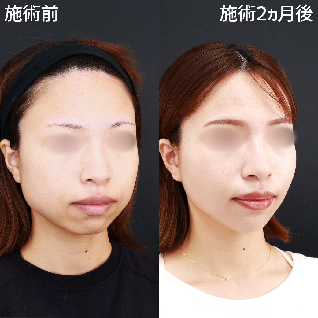 小顔整形｜パーフェクトフェイスライン/TAC式 ツヤ肌コラーゲンリフト®/バッカルファット除去の症例写真 施術前後 