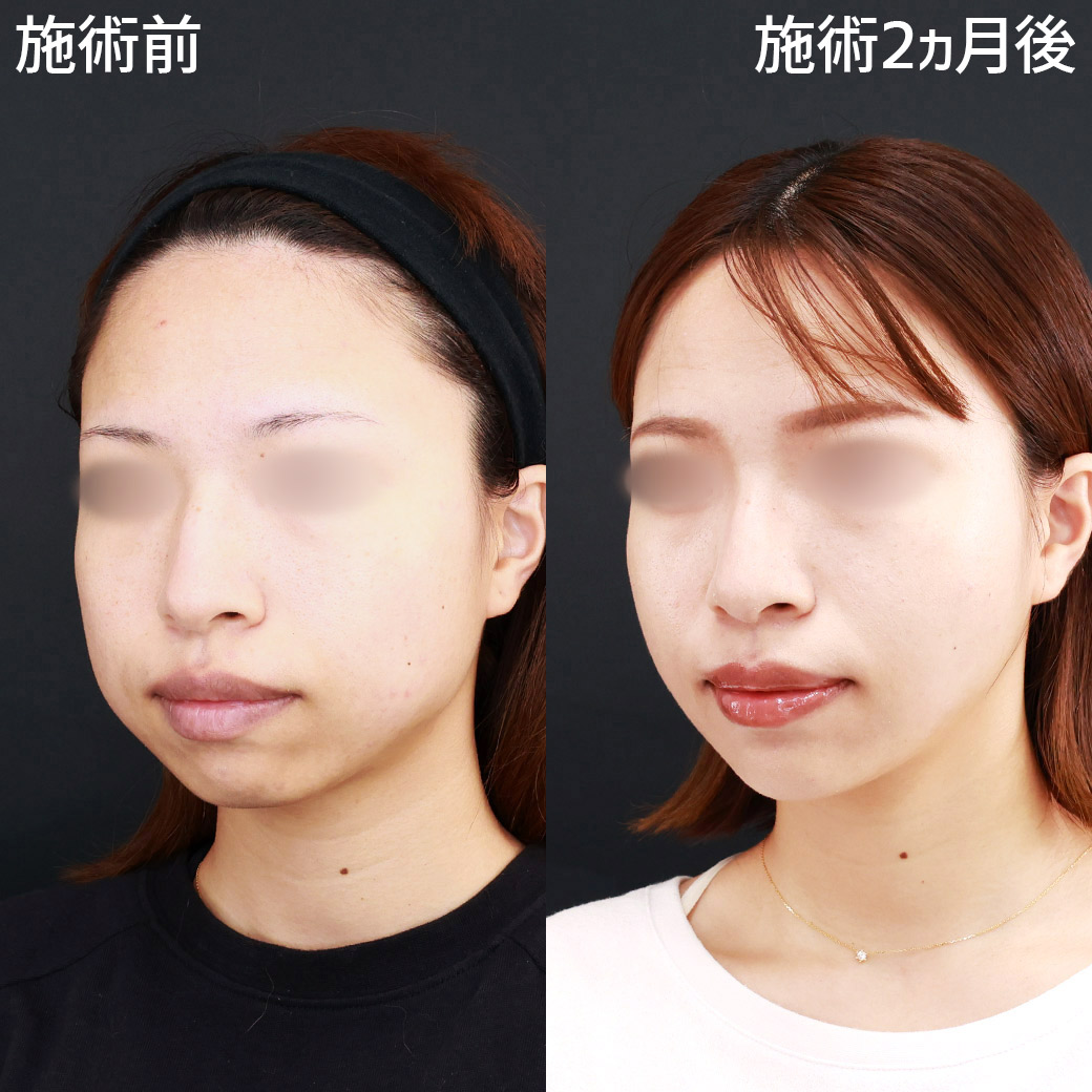 小顔整形｜パーフェクトフェイスライン/TAC式 ツヤ肌コラーゲンリフト®/バッカルファット除去の症例写真 施術前後 