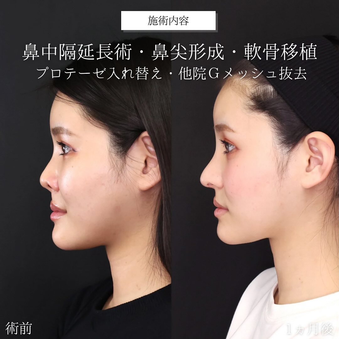 鼻中隔延長術/鼻尖形成・鼻尖縮小/鼻先軟骨移植の症例写真 施術前後 