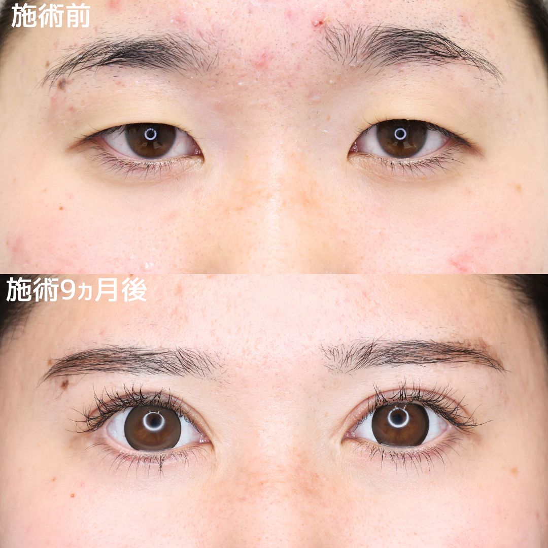 二重切開（全切開法）/眼瞼下垂（目つき矯正）/グラマラスライン（タレ目形成）の症例写真 施術前後 