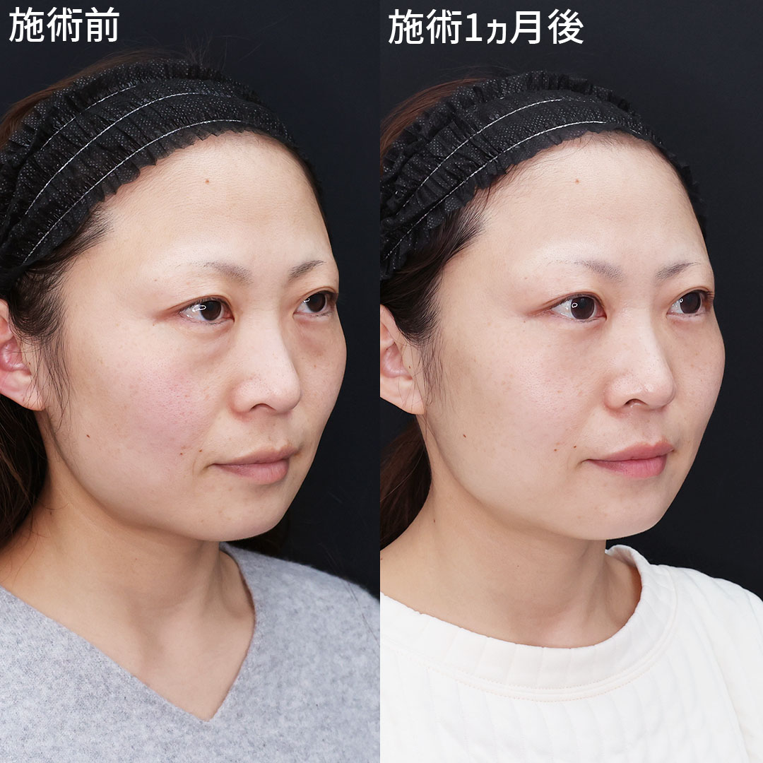 下眼瞼脱脂術（目の下のたるみ取り・目の下の脂肪ふくらみ取り）の症例写真 施術前後 