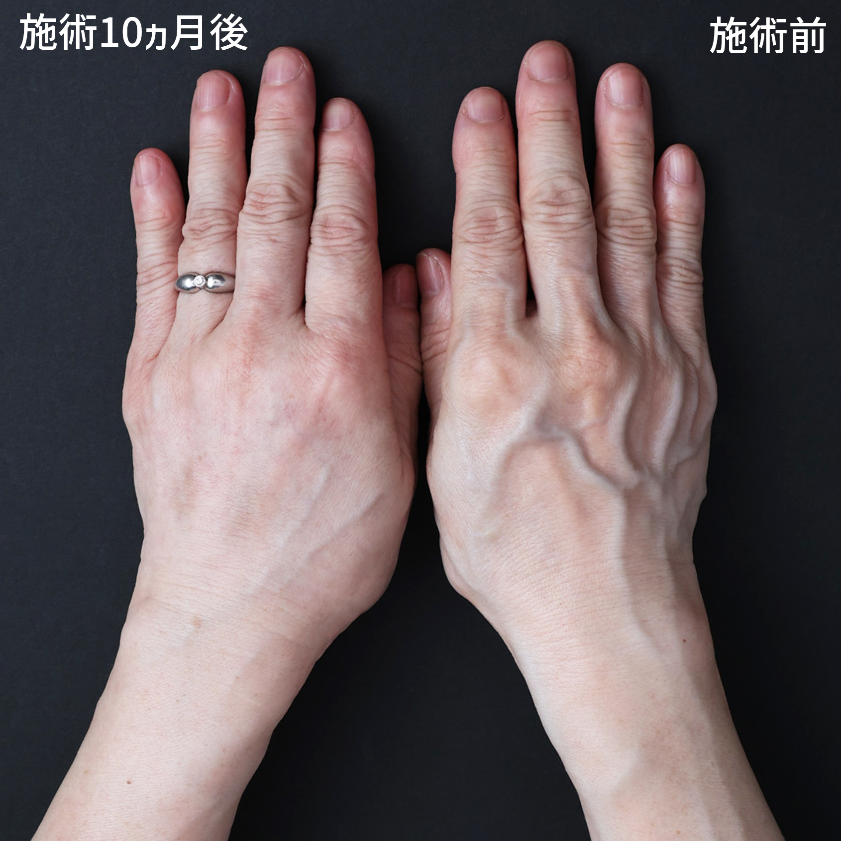 ハンドベイン（手のアンチエイジング・血管治療）の症例写真 施術前後 