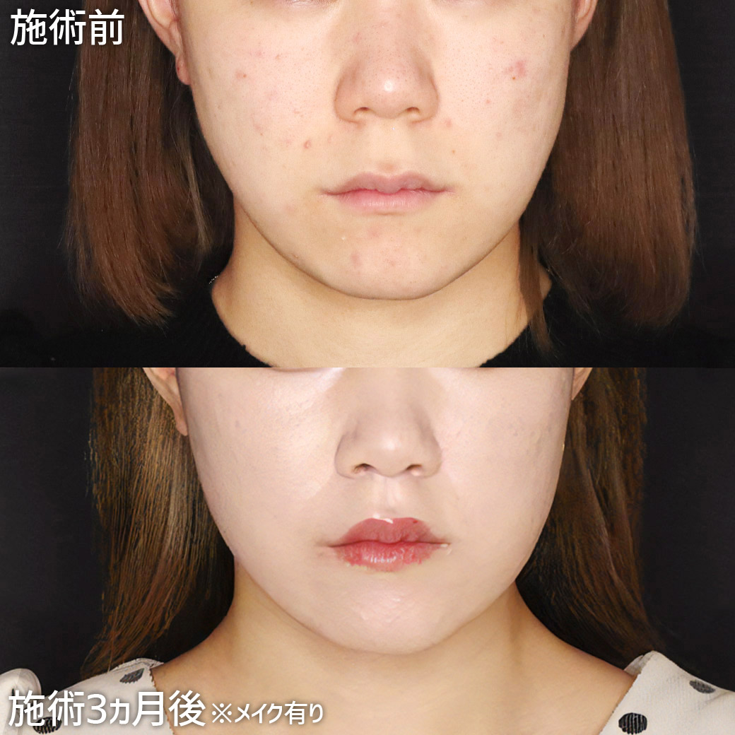 人中短縮術(リップリフト)・外側人中短縮術の症例写真 施術前後 