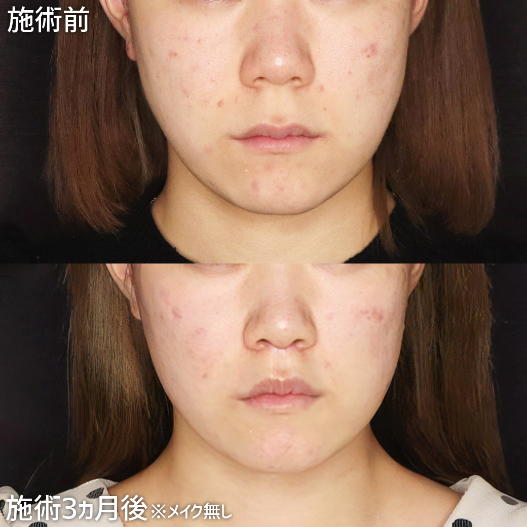 人中短縮術(リップリフト)・外側人中短縮術の症例写真 施術前後 