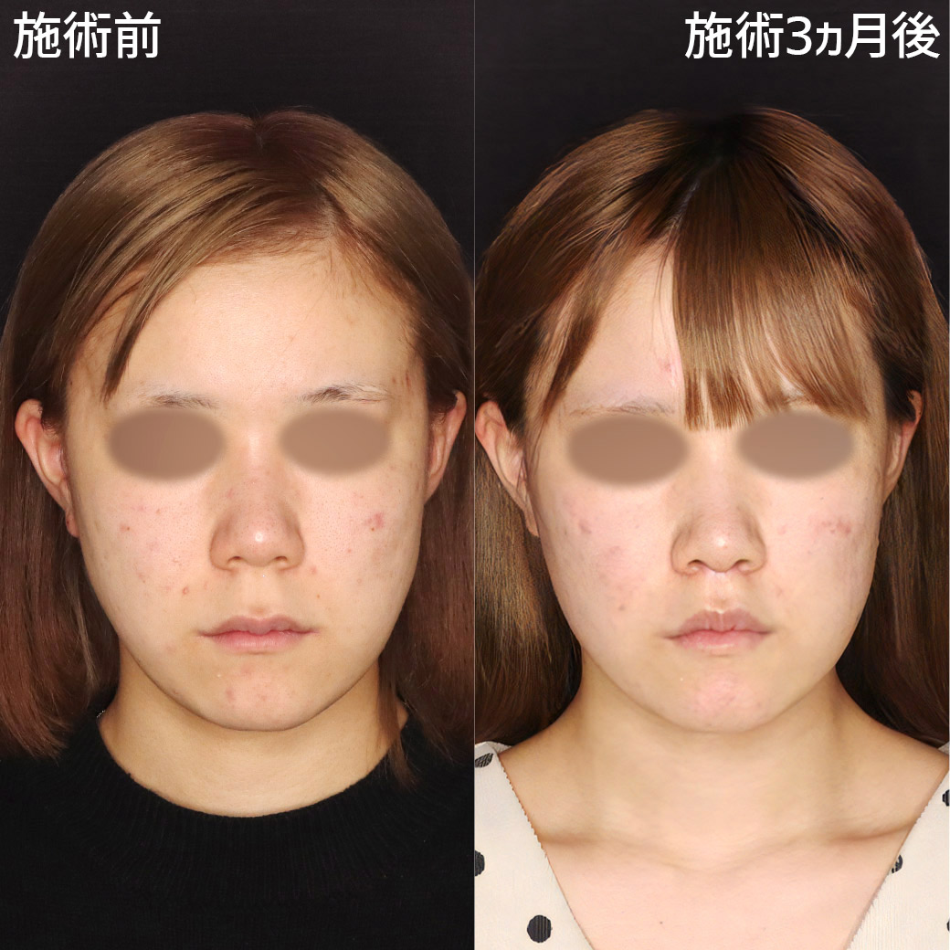 人中短縮術(リップリフト)・外側人中短縮術の症例写真 施術前後 