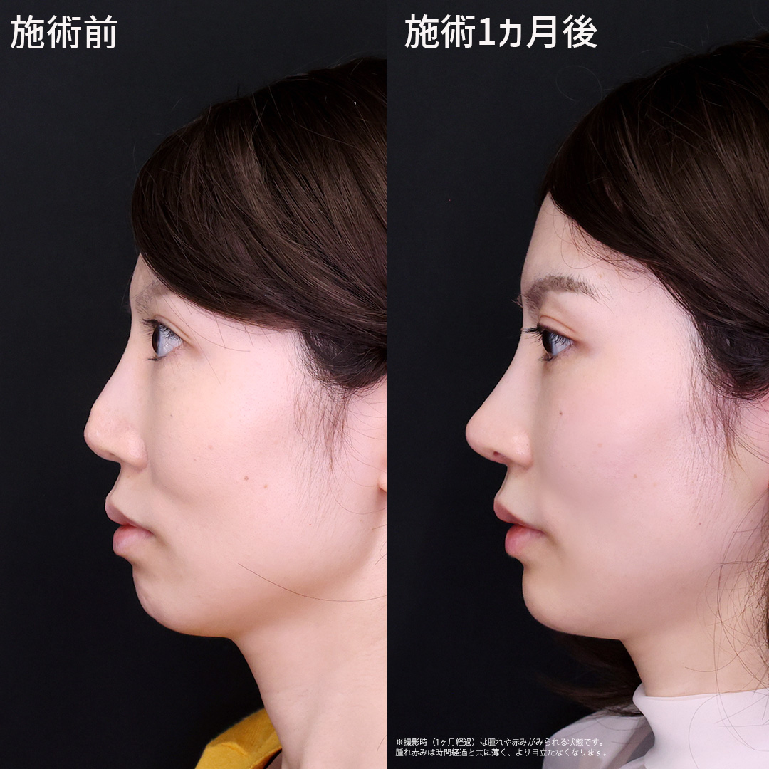 鼻中隔延長術/鼻尖形成・鼻尖縮小/鼻先軟骨移植の症例写真 施術前後 