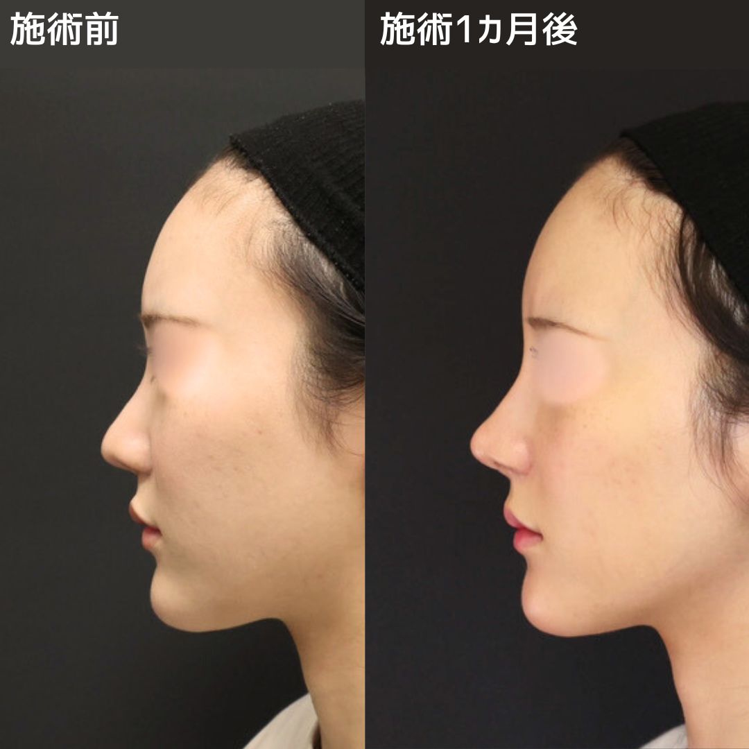 隆鼻術（プロテーゼ・自家組織）/鼻中隔延長術/鼻孔縁挙上術の症例写真 施術前後 