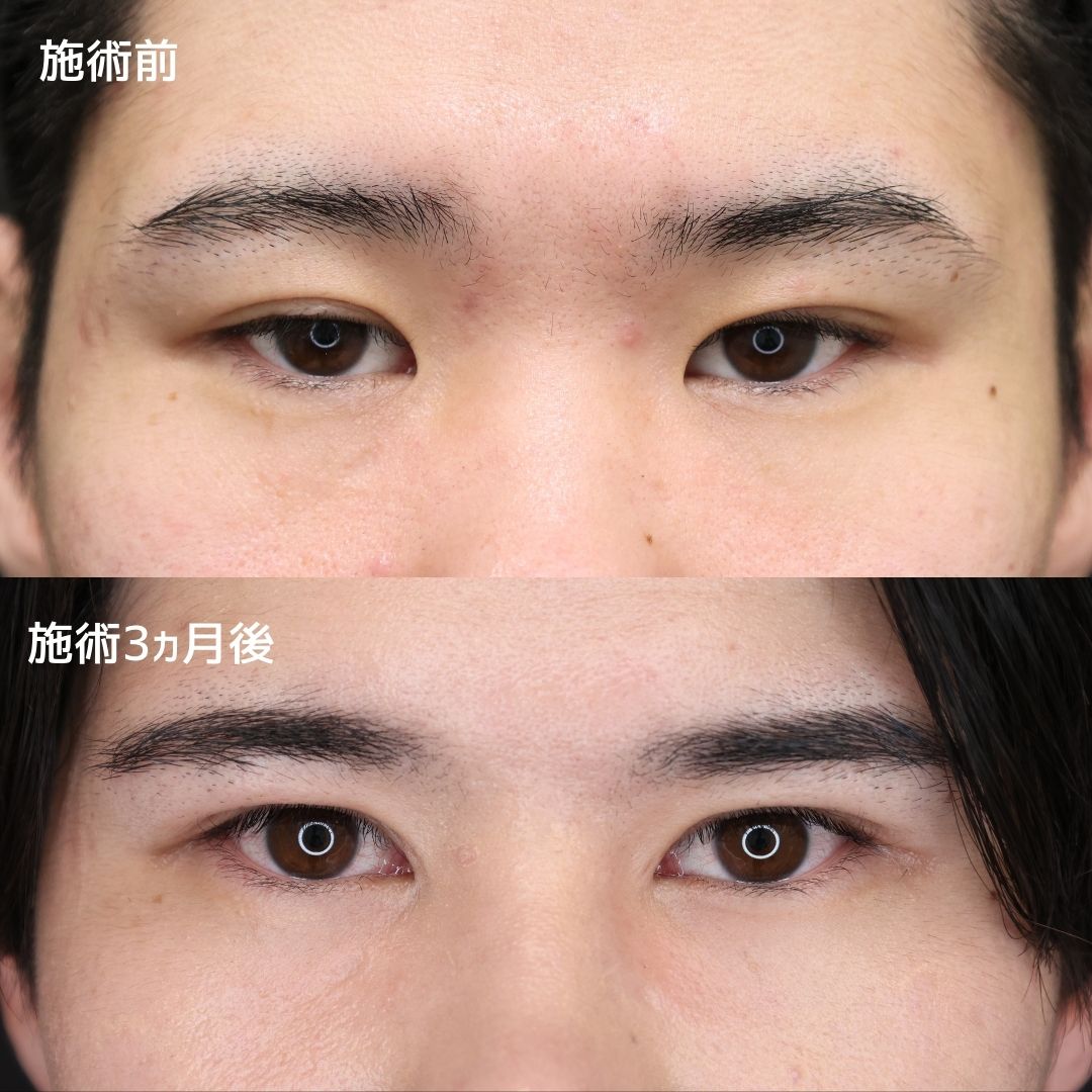 目頭切開術/眼瞼下垂（目つき矯正）の症例写真 施術前後 