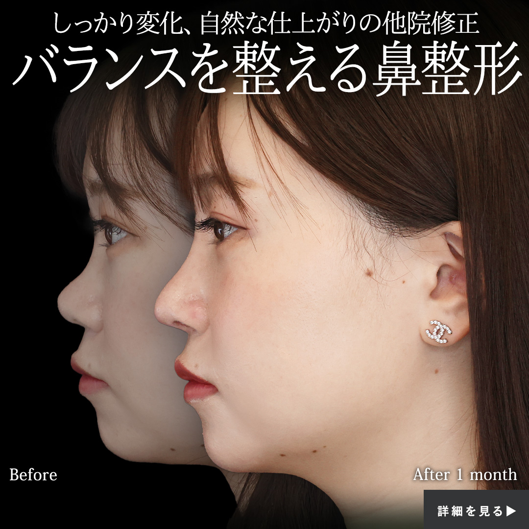 隆鼻術（プロテーゼ・自家組織）/鼻尖形成・鼻尖縮小/鼻中隔延長術の症例写真 施術前後 