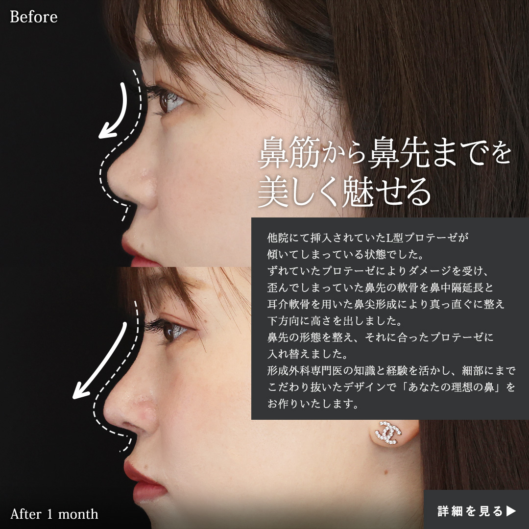 隆鼻術（プロテーゼ・自家組織）/鼻尖形成・鼻尖縮小/鼻中隔延長術の症例写真 施術前後 