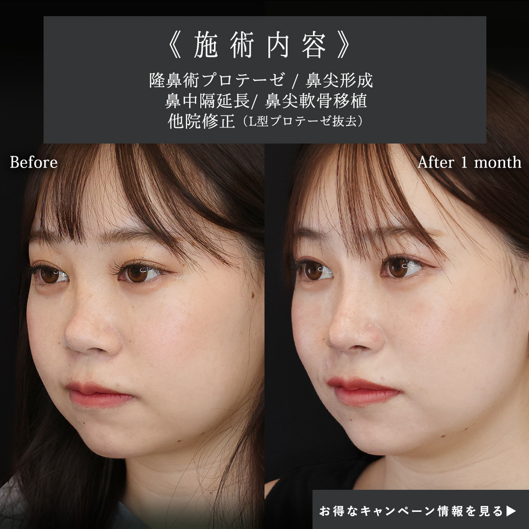 隆鼻術（プロテーゼ・自家組織）/鼻尖形成・鼻尖縮小/鼻中隔延長術の症例写真 施術前後 