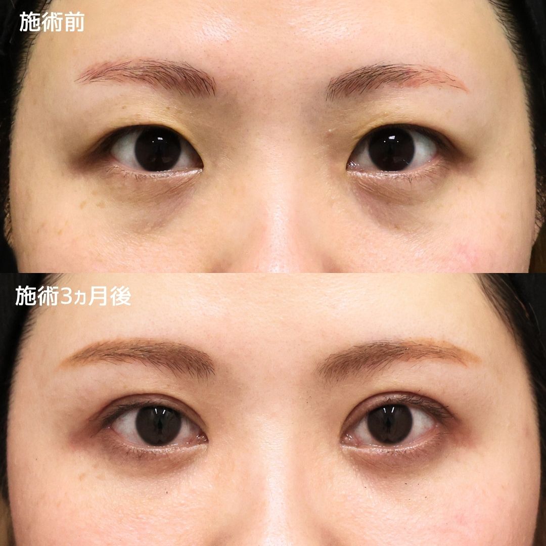 上眼瞼切開術/目頭切開術の症例写真 施術前後 