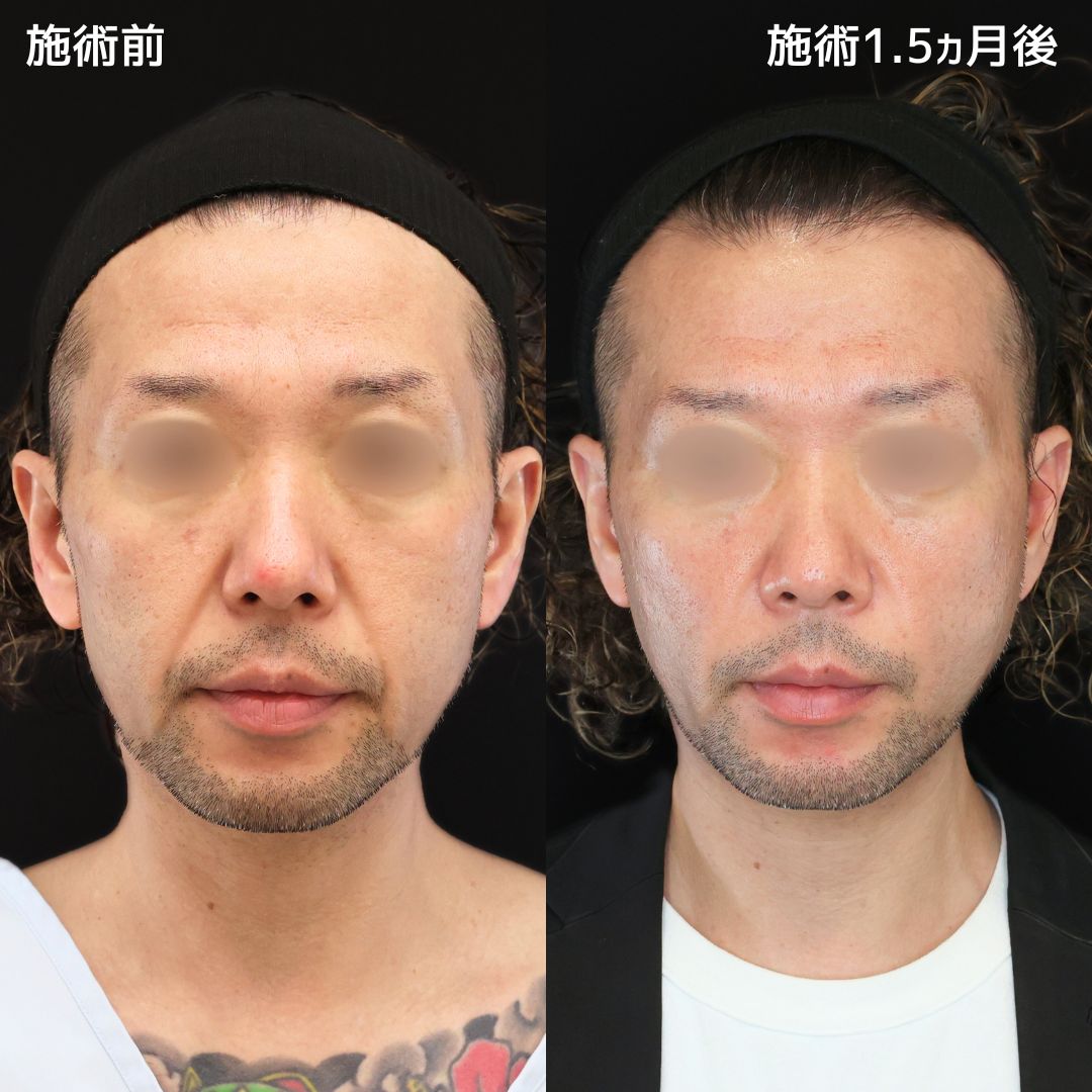 ナゾラビアルファット除去/ほうれい線のヒアルロン酸注射/TAC式 ツヤ肌コラーゲンリフト®の症例写真 施術前後 