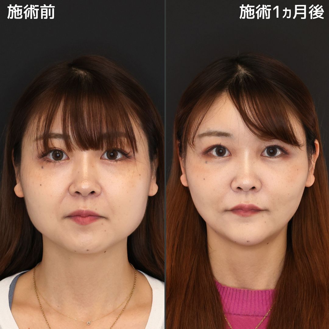 バッカルファット除去/ジョールファット除去/顎下の脂肪吸引の症例写真 施術前後 
