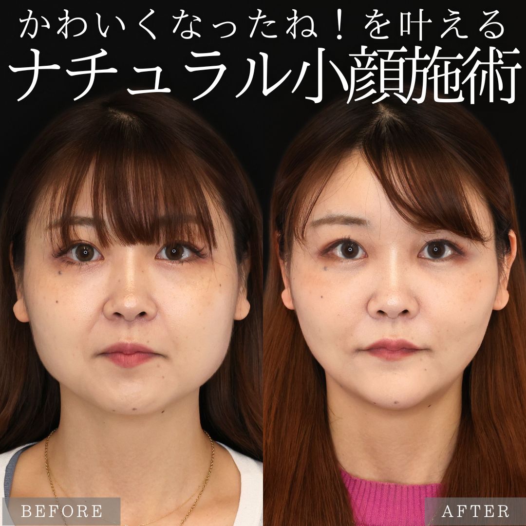 バッカルファット除去/ジョールファット除去/顎下の脂肪吸引の症例写真 施術前後 