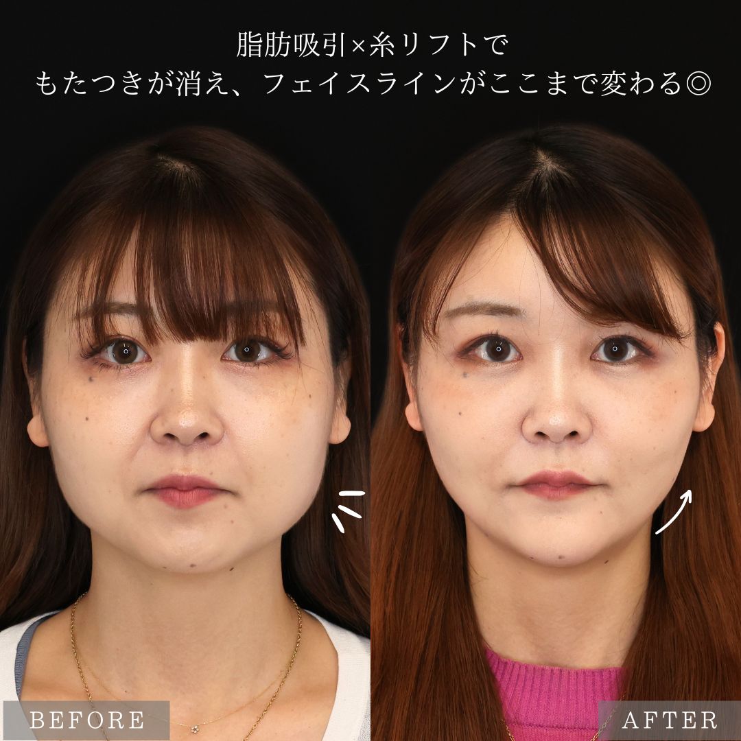 バッカルファット除去/ジョールファット除去/顎下の脂肪吸引の症例写真 施術前後 