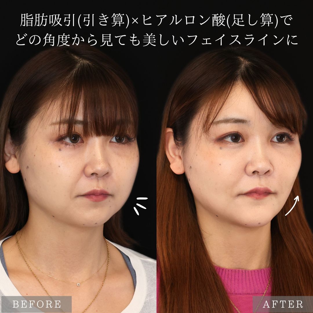 バッカルファット除去/ジョールファット除去/顎下の脂肪吸引の症例写真 施術前後 