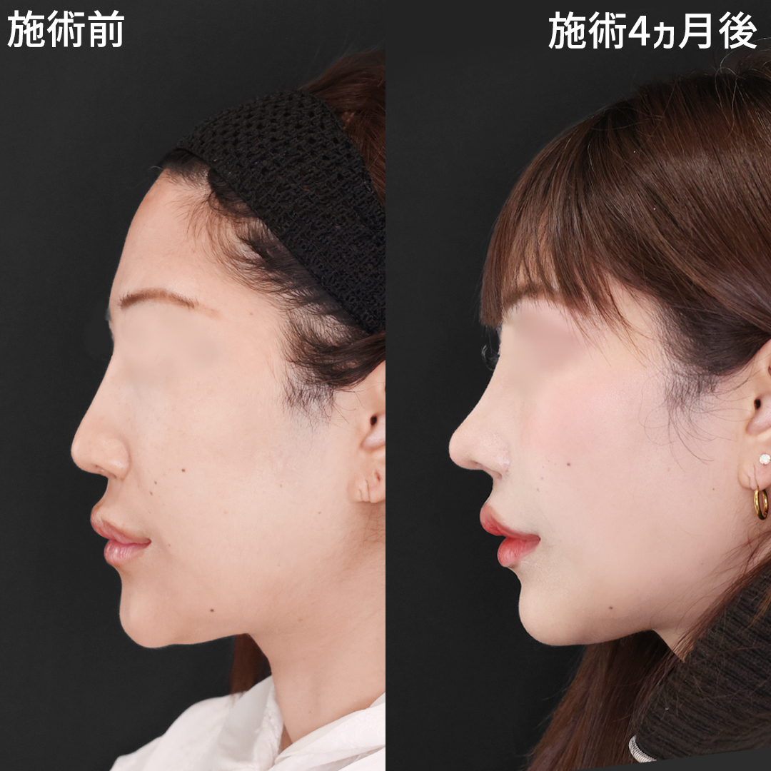 鼻中隔延長術/鼻尖形成・鼻尖縮小/M字リップ形成術の症例写真 施術前後 
