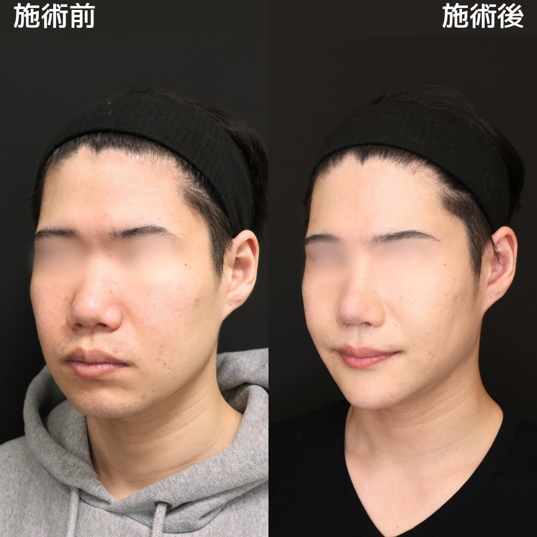 TAC式 ツヤ肌コラーゲンリフト®/小顔整形｜パーフェクトフェイスライン/バッカルファット除去の症例写真 施術前後 