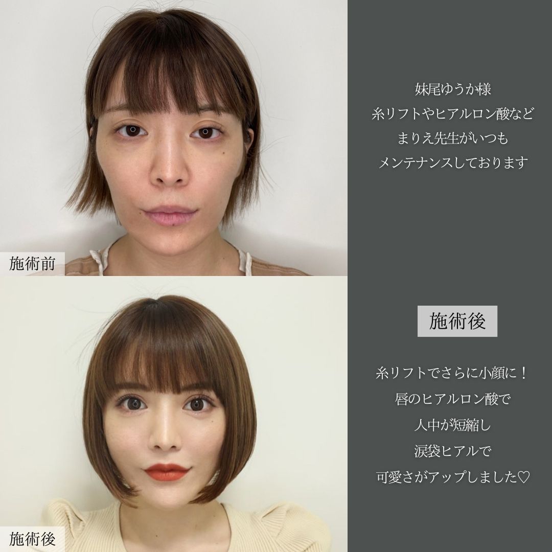 TAC式 ツヤ肌コラーゲンリフト®/ほうれい線のヒアルロン酸注射/顎のヒアルロン酸注射の症例写真 施術前後 