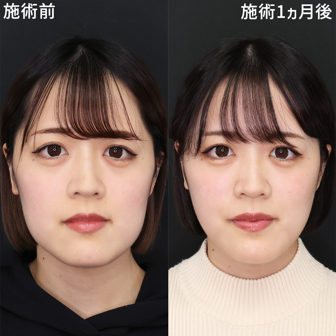 TAC式 ツヤ肌コラーゲンリフト®/Lラインファット除去（エラ下脂肪除去）/ジョールファット除去の症例写真 施術前後 