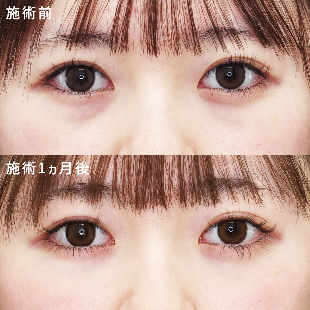下眼瞼脱脂術（目の下のたるみ取り・目の下の脂肪ふくらみ取り）/ゴルゴ線のヒアルロン酸注射/目の下のヒアルロン酸注射の症例写真 施術前後 
