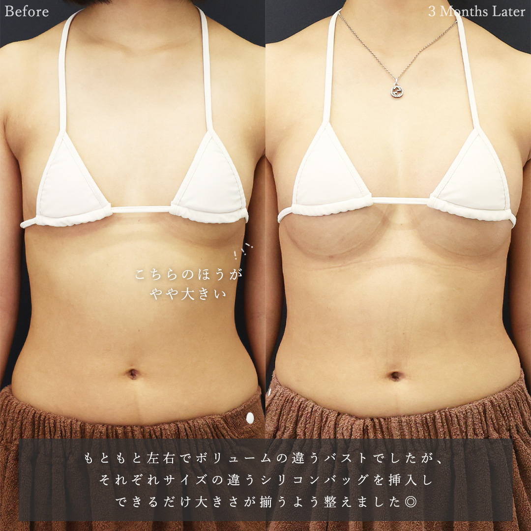 シリコンバッグ豊胸（人工乳腺バッグ）の症例写真 施術前後 