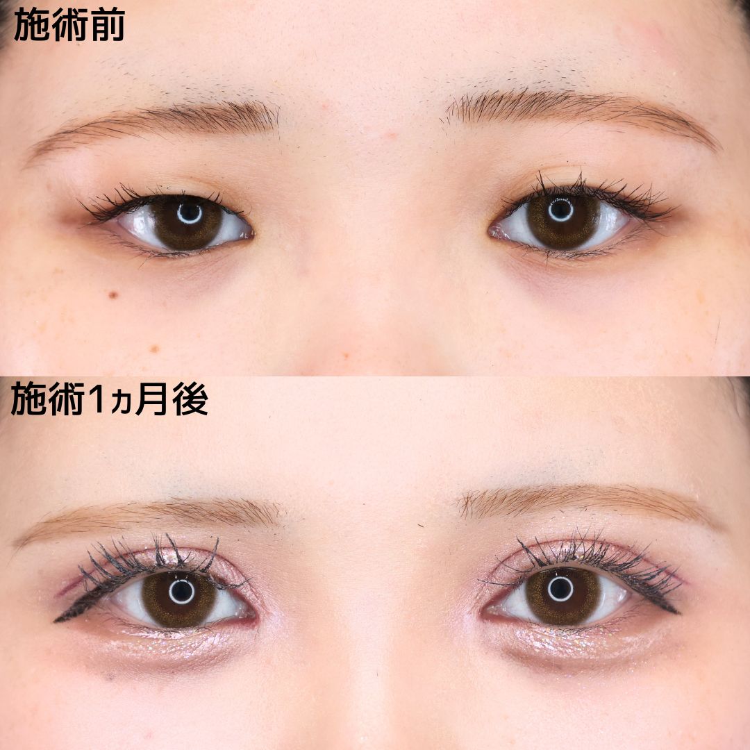上眼瞼切開術/目頭切開術の症例写真 施術前後 