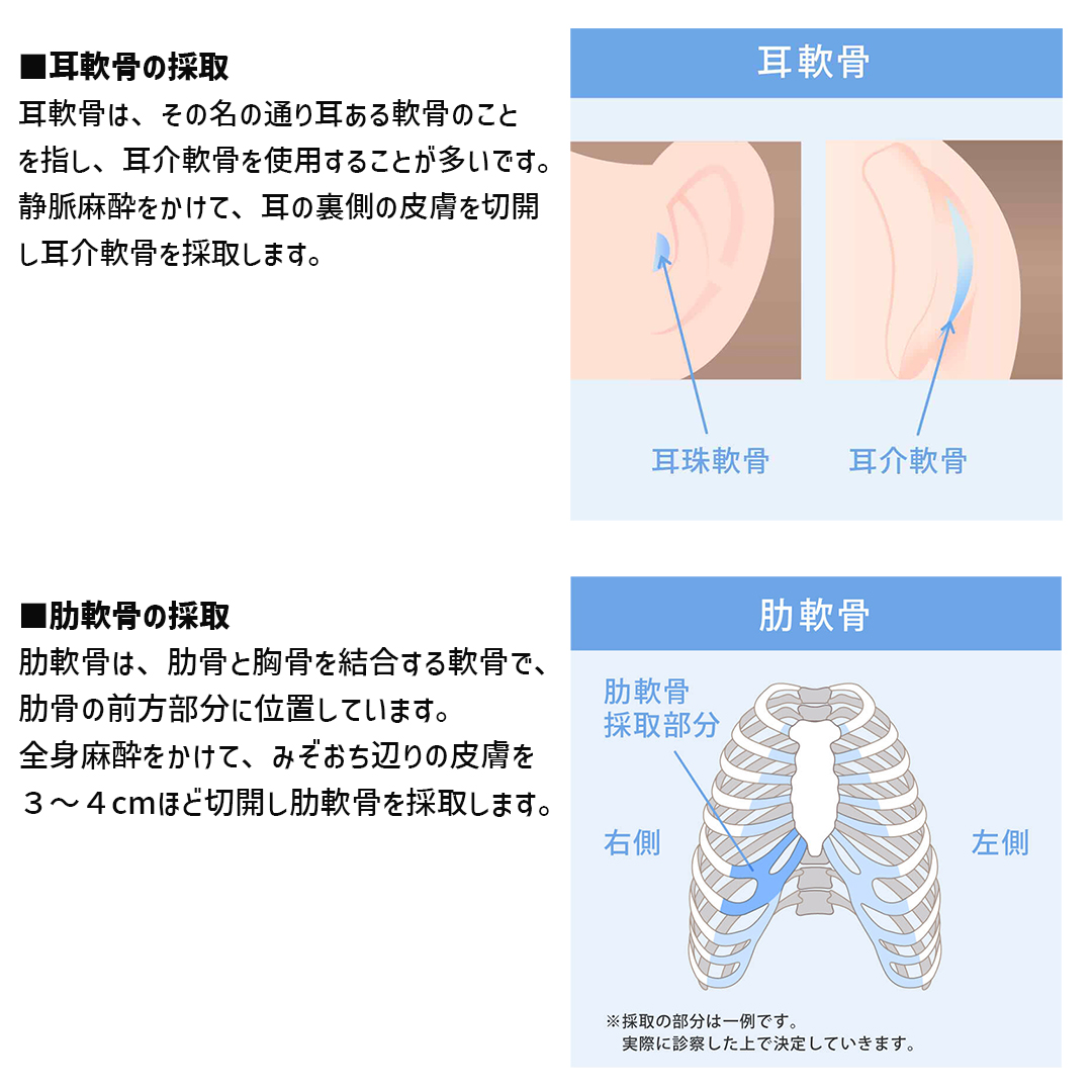 隆鼻術（プロテーゼ・自家組織）/鼻中隔延長術/鼻尖形成・鼻尖縮小の症例写真 施術前後 