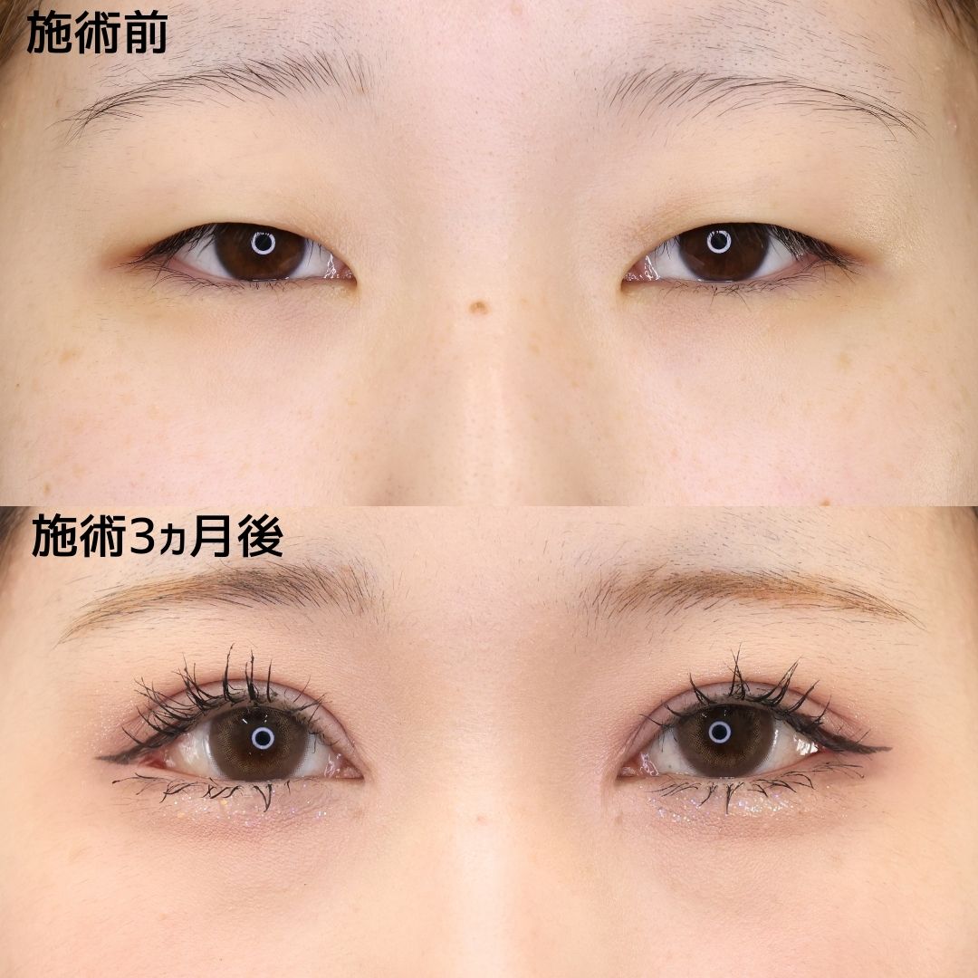 上眼瞼切開術/眼瞼下垂（目つき矯正）/目頭切開術の症例写真 施術前後 