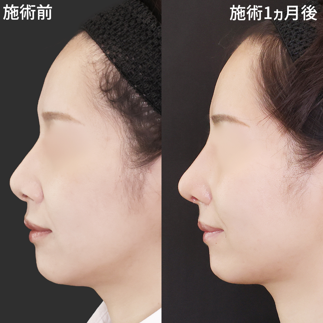 鼻尖形成・鼻尖縮小/鼻先軟骨移植/鼻中隔延長術の症例写真 施術前後 