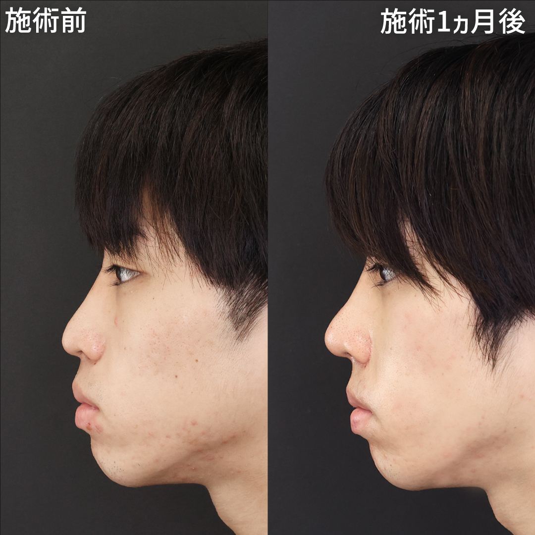 鼻中隔延長術/鼻尖形成・鼻尖縮小/鼻先軟骨移植の症例写真 施術前後 