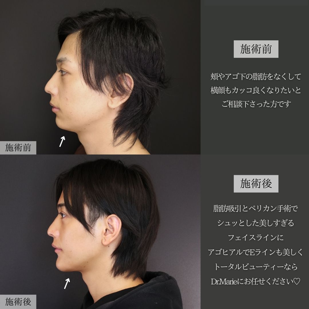 顎下の脂肪吸引/TAC式 ツヤ肌コラーゲンリフト®/人中短縮術(リップリフト)・外側人中短縮術の症例写真 施術前後 