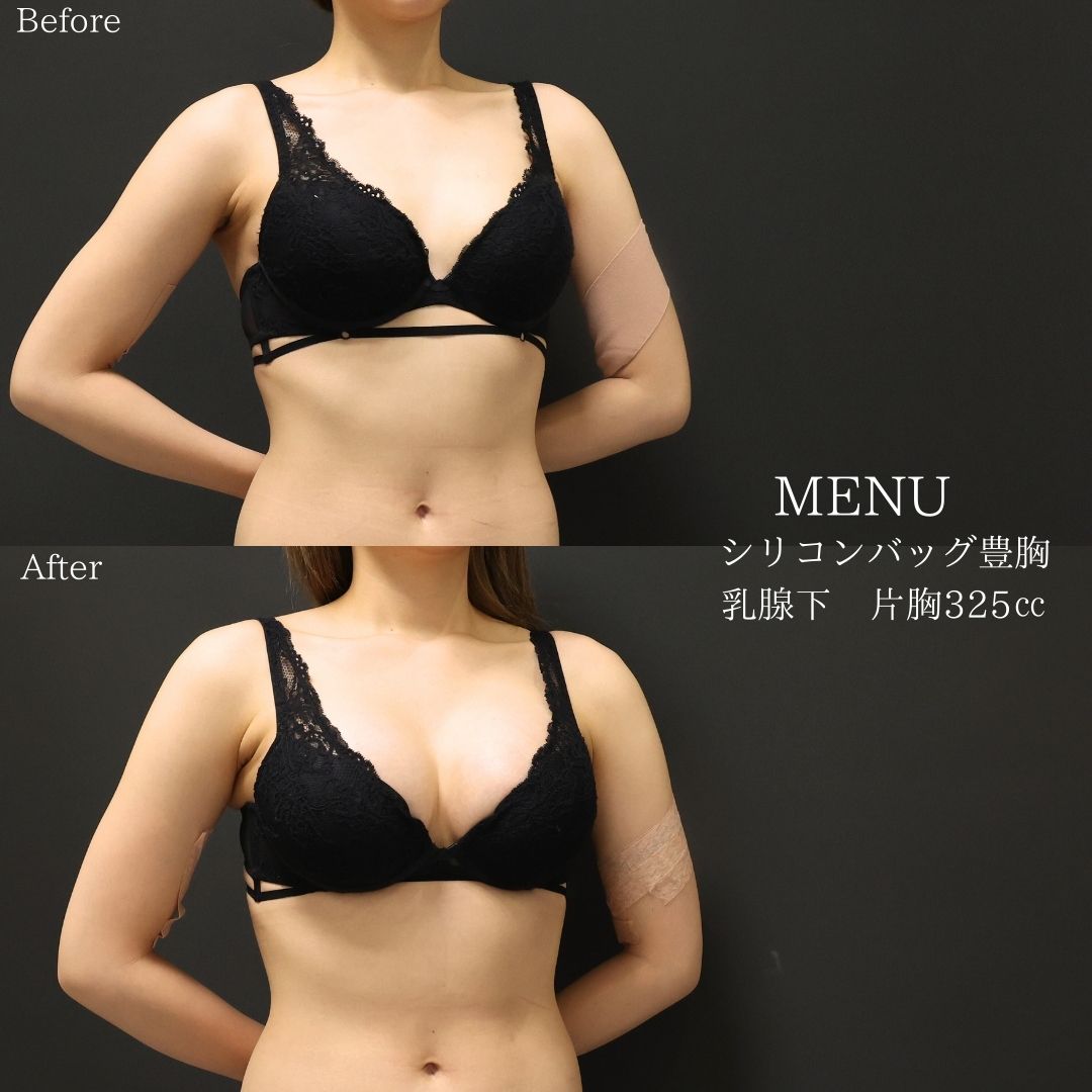 シリコンバッグ豊胸（人工乳腺バッグ）の症例写真 施術前後 