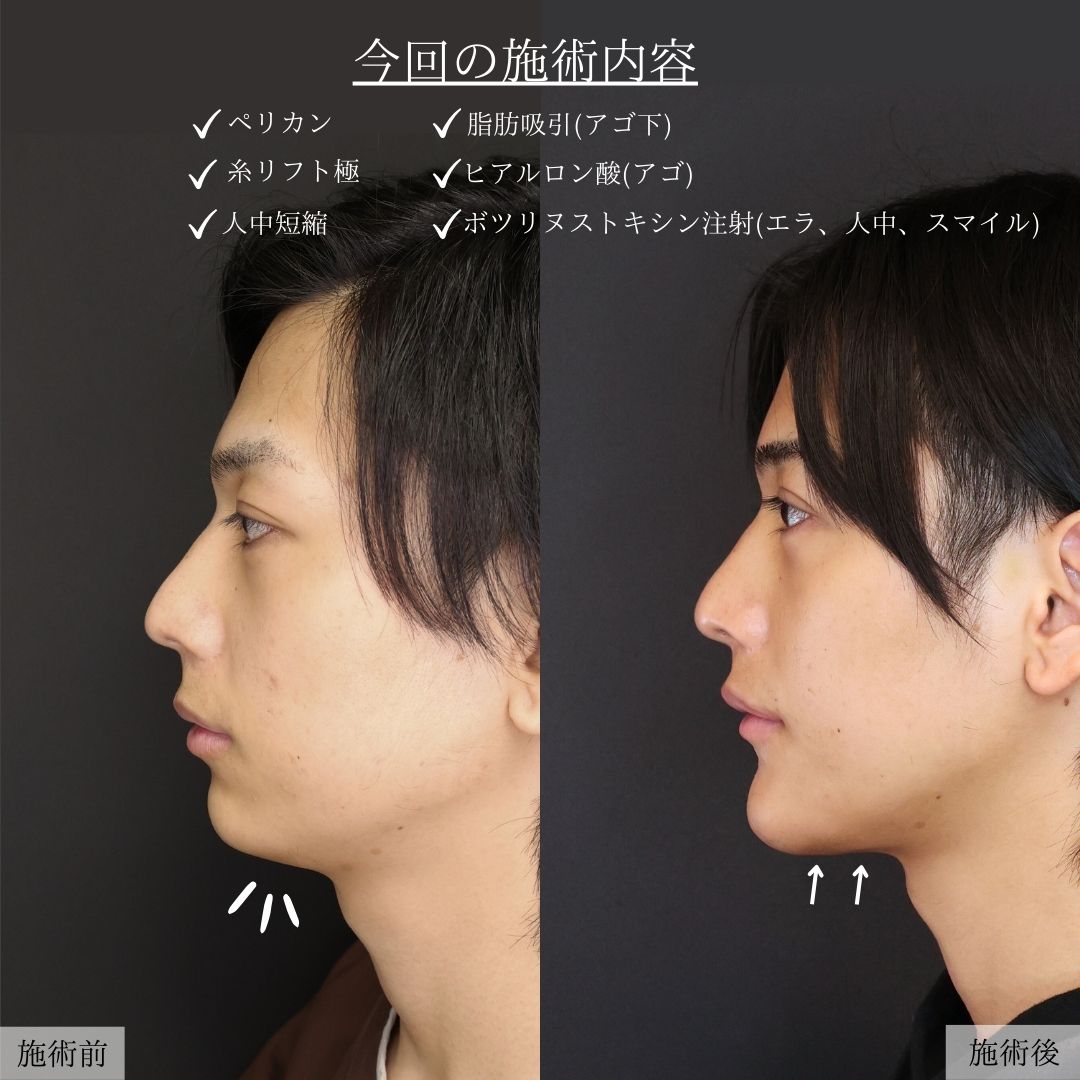 顎下の脂肪吸引/TAC式 ツヤ肌コラーゲンリフト®/人中短縮術(リップリフト)・外側人中短縮術の症例写真 施術前後 
