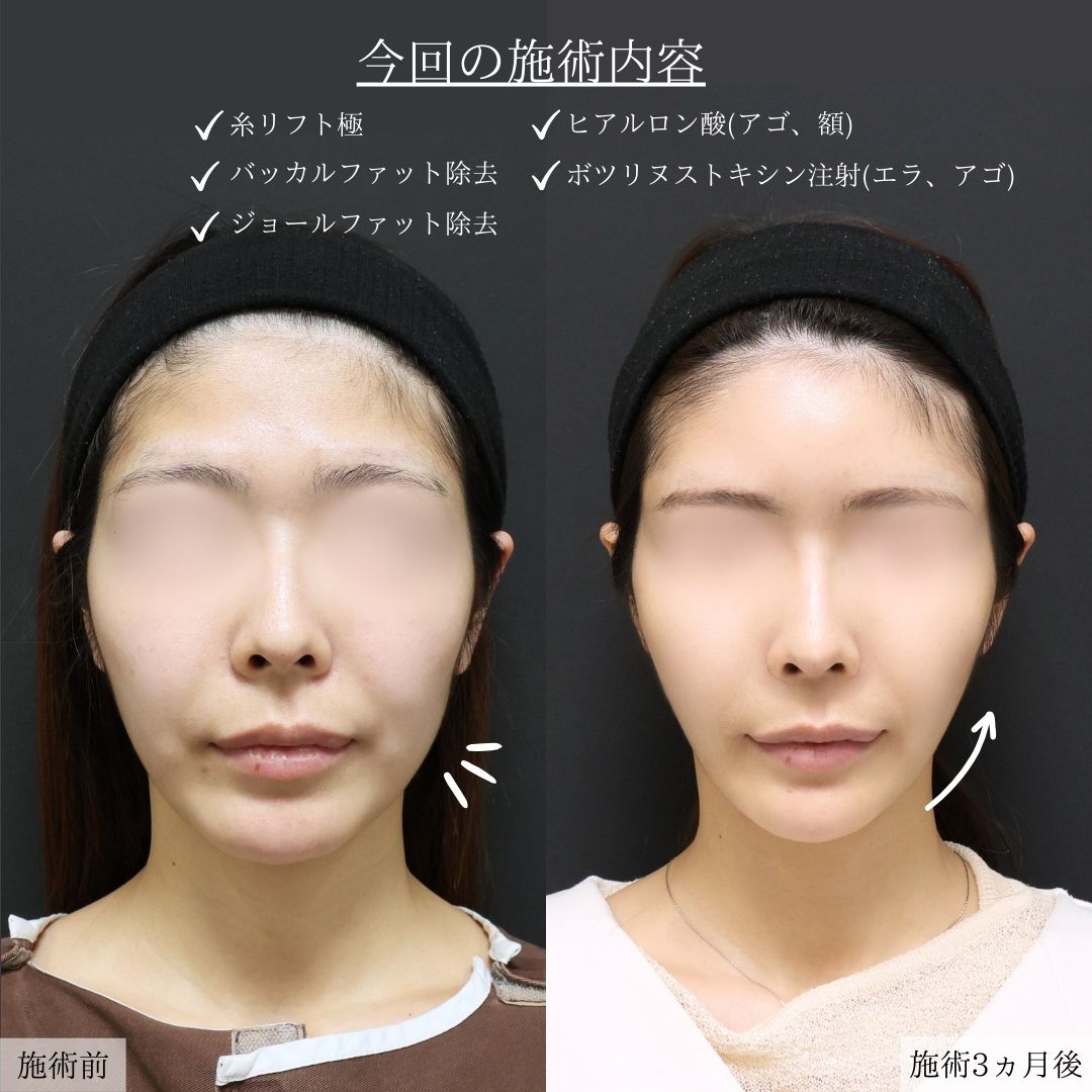 TAC式 ツヤ肌コラーゲンリフト®/ジョールファット除去/バッカルファット除去の症例写真 施術前後 