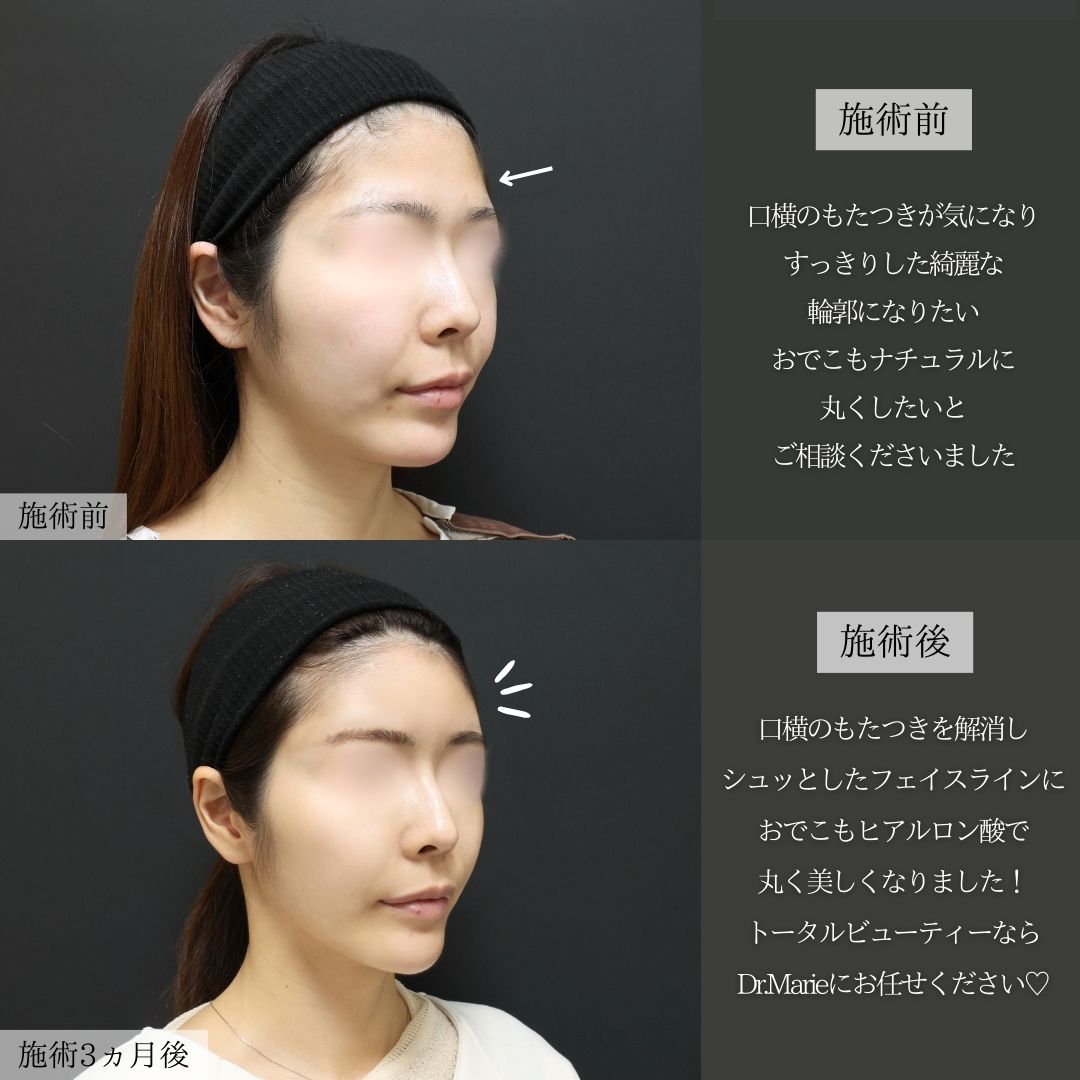 TAC式 ツヤ肌コラーゲンリフト®/ジョールファット除去/バッカルファット除去の症例写真 施術前後 