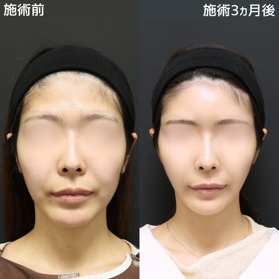 TAC式 ツヤ肌コラーゲンリフト®/ジョールファット除去/バッカルファット除去の症例写真 施術前後 