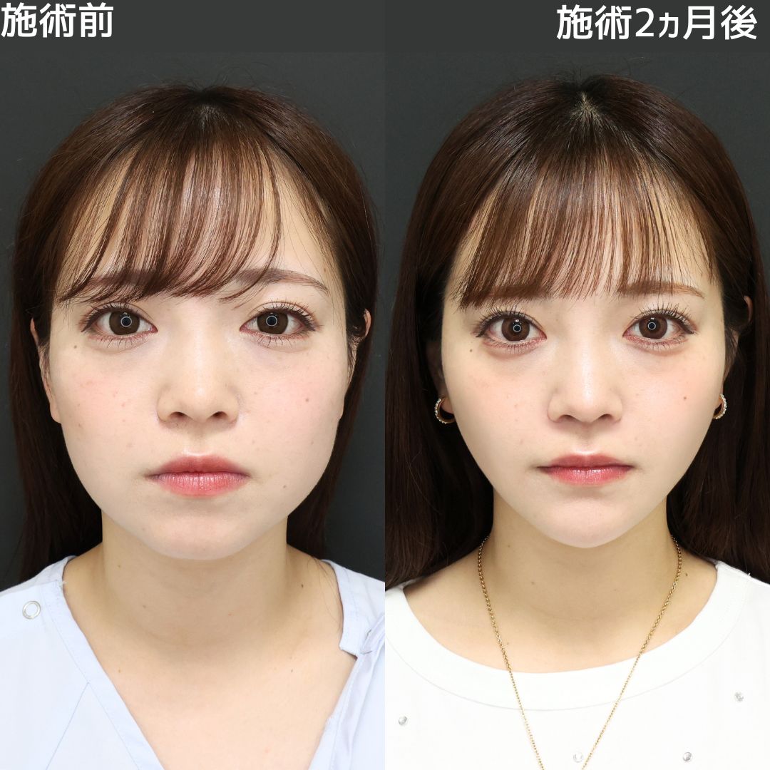 TAC式 ツヤ肌コラーゲンリフト®/バッカルファット除去/ジョールファット除去の症例写真 施術前後 