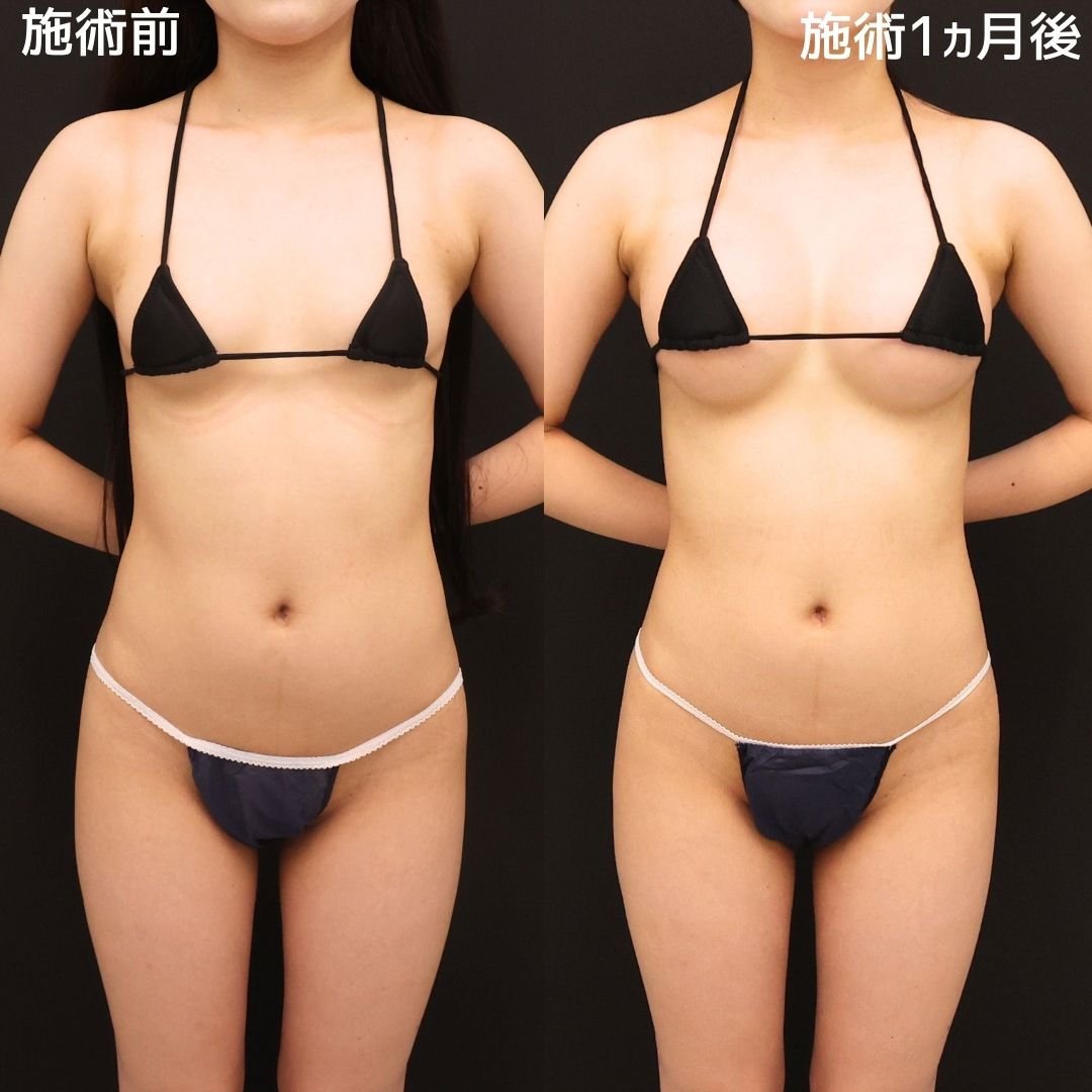シリコンバッグ豊胸（人工乳腺バッグ）/ボトックス注射：その他の症例写真 施術前後 
