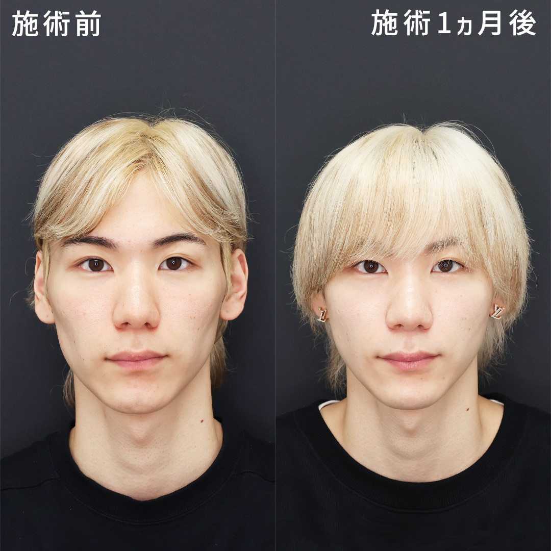 TAC式 ツヤ肌コラーゲンリフト®/ゴルゴ線のヒアルロン酸注射/顎のヒアルロン酸注射の症例写真 施術前後 
