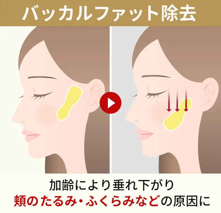 バッカルファットとは